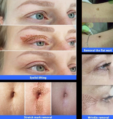 100%Korea Fibroblast plasma pen jet plasmalift Face Eyelid Lift plamere premium plaxpot plamon plaxel+ plasma pen